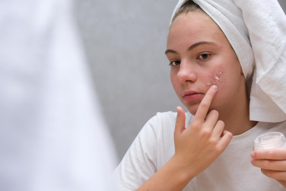 Scapă de acneea corporală: Sfaturi de la dermatologi